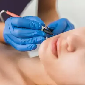 electrolysis hair removal