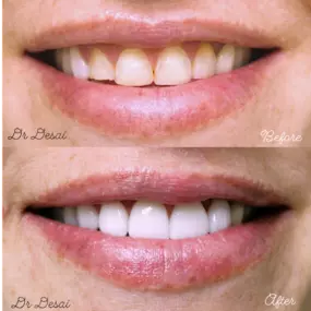 Teeth Whitening - Larwin Square Dentistry Tustin