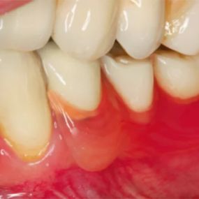 Valplast-Prosthese | Ritter Dentallabor | München-Obergiesing