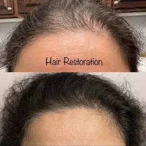 Best Hair Restoration Medical Spa in Issaquah, Washington