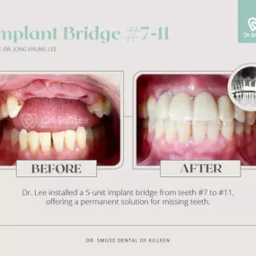 ​Dr. SmiLee Dental of Killeen Dental Implant, Family, Cosmetic, Emergency, IV Sedation, Braces, Facial Esthetics  | Address: 1001 S Fort Hood St Ste 1001 B, Killeen, TX 76541 | Call: 254-342-3292