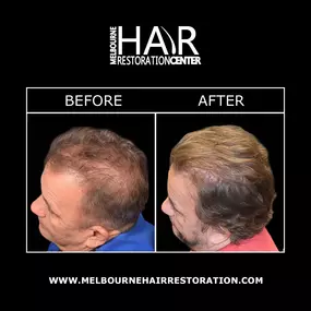 Advances in hair restoration technology have improved the techniques, safety, and results of hair restoration. At Melbourne Hair Restoration Center, our doctors are trained in various methods such as SmartGraft, NeoGraft®, Artas®, and the Follicle Unit Extraction to provide you with natural-looking, long-lasting results.