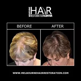 Melbourne Hair Restoration Center provides stem cell hair restoration. This non-surgical hair restoration method differs from treatments that rely on relocating hair follicles. Stem cell hair therapy is designed to restore growth of natural hair follicles and achieve long-lasting results.