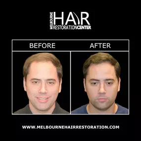 Our Melbourne hair surgeons use the most advanced hair transplant techniques available to achieve natural-looking, long-lasting results. Patients can expect thicker, fuller hair volume following treatment. Dr. Bassin & the Melbourne Hair Restoration team can discuss your options with you to determine the best procedure(s) to meet your goals.