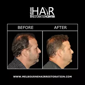 Melbourne Hair Restoration Center offers the most innovative hair transplant technology available. Artas® hair restoration is a groundbreaking, minimally invasive way to transplant hair for optimal results. Artas® utilizes cutting-edge robotic technology & digital imaging to select the healthiest hair follicles for transplant. These follicles are then inserted into areas where hair has thinned to restore a fuller, natural head of hair.