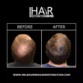 SmartGraft® hair restoration encourages the growth of thick, healthy hair with faster, more precise hair restoration results than previous methods. SmartGraft® utilizes a “closed harvesting system” to extract your own hair follicles with precision and efficiency to place in areas of thinning hair.