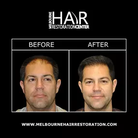 NeoGraft® is a minimally invasive, automated hair replacement method without lengthy procedures or linear scarring. NeoGraft® allows our doctors at Melbourne Hair Restoration Center to control the individual placement of each follicle, creating a natural-looking hairline.