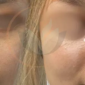 Before & After Non-Surgical Rhinoplasty