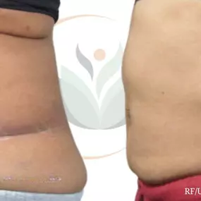 Before & After Non-Surgical Fat Reduction