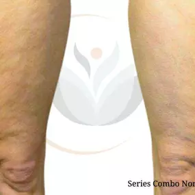 Before & After Cellulite Reduction / Skin Tightening