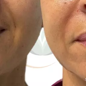 Before & After Dermal Fillers, Laugh Lines