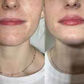 before and after microneedling