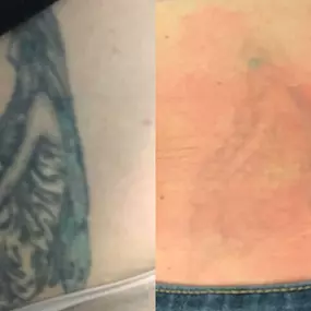 Bild von TakeTatt Tattoo Removal