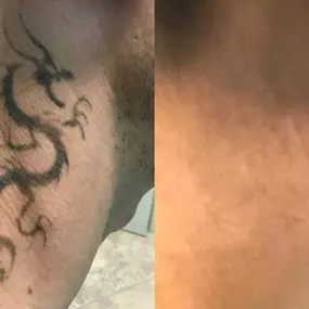 Bild von TakeTatt Tattoo Removal