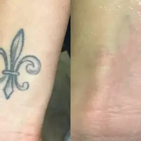 Bild von TakeTatt Tattoo Removal