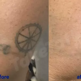 Bild von TakeTatt Tattoo Removal