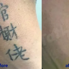 Bild von TakeTatt Tattoo Removal