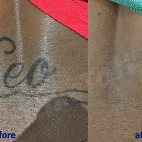 Bild von TakeTatt Tattoo Removal