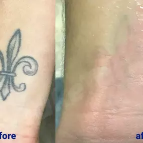 Bild von TakeTatt Tattoo Removal