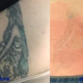 Bild von TakeTatt Tattoo Removal