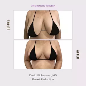 Transform Your Silhouette with Expert Breast Reduction: Before and After Results by Dr. David Globerman at My Cosmetic Surgery in Miami