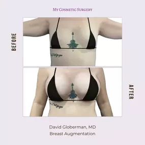 Stunning Breast Augmentation Results with Dr. David Globerman, MD: Before and After at My Cosmetic Surgery in Miami