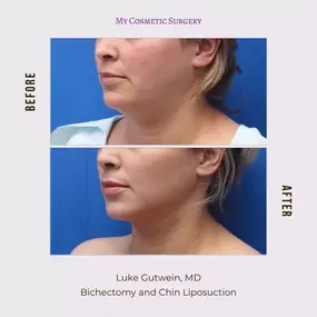 Achieve a Sculpted Profile: Bichectomy and Chin Lipo Results in Miami