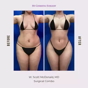 Transform your look with our surgical combo packages at My Cosmetic Surgery Miami! Check out these stunning before-and-after results that showcase the artistry of our skilled surgeons. Your dream body is just a consultation away!