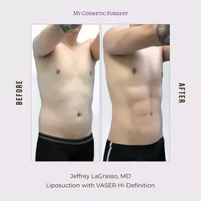 Transform Your Contours with VASER Hi-Def Liposuction in Miami