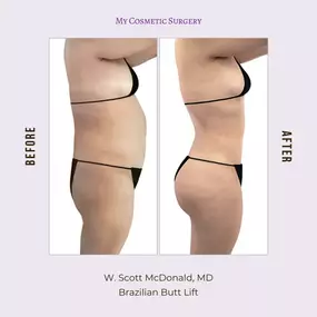 Achieve Your Dream Curves with a Brazilian Butt Lift by Dr. W. Scott McDonald at My Cosmetic Surgery in Miami!