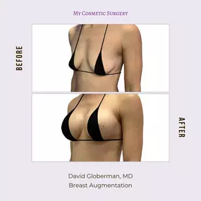 Transform Your Silhouette with Breast Augmentation: Before and After Results at My Cosmetic Surgery in Miami