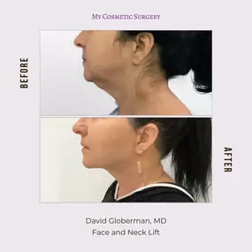 Reclaim Your Youthful Appearance with Face and Neck Lift: Before and After Results at My Cosmetic Surgery in Miami