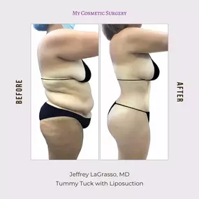 Achieve a Sleeker Silhouette with Tummy Tuck and Liposuction by Dr. Jeffrey Lagrasso at My Cosmetic Surgery in Miami!