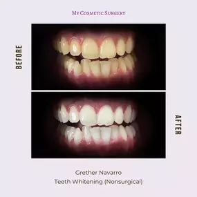 Achieve a Dazzling Smile with Nonsurgical Teeth Whitening by Grether Navarro at My Cosmetic Surgery in Miami