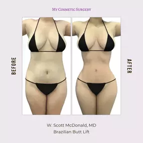 Achieve Your Dream Curves with a Brazilian Butt Lift by Dr. W. Scott McDonald at My Cosmetic Surgery in Miami!