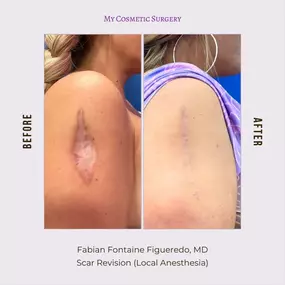 Expert Scar Revision with Dr. Fabian Fontaine Figueredo, MD, at My Cosmetic Surgery in Miami