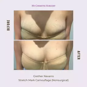 Restore Your Skin’s Confidence with Stretch Mark Camouflage by Grether Navarro at My Cosmetic Surgery in Miami