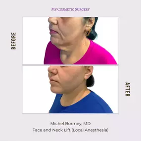 Remarkable Before and After of a Face and Neck Lift by Dr. Michel Bormey, MD at My Cosmetic Surgery.