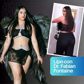 Transformación de Lipo Antes y Después con el Dr. Fabian Fontaine en My Cosmetic Surgery Miami