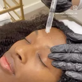 microneedling