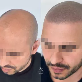 A hairline tattoo, known professionally as scalp micropigmentation, offers a life-changing solution for those seeking a natural-looking hairline. This technique uses specialized pigments and precise application to mimic hair follicles, creating the appearance of a fuller, denser hairline. Whether you’re experiencing thinning, balding, or simply want a more defined hairline, scalp micropigmentation is an ideal choice.

So, how does it work? 

During a hairline tattoo session, tiny dots are carefu