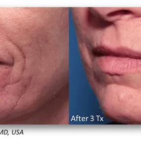 RF MICRONEEDLING