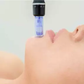 Microneedling