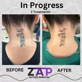 Bild von ZAP Tattoo Removal in Plano, TX