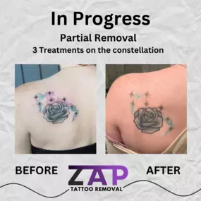 Bild von ZAP Tattoo Removal in Plano, TX