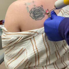 Bild von ZAP Tattoo Removal in Plano, TX
