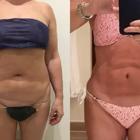 Before & After Vaser 4D lipo