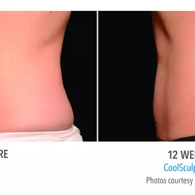Coolsculpting Centennial, CO