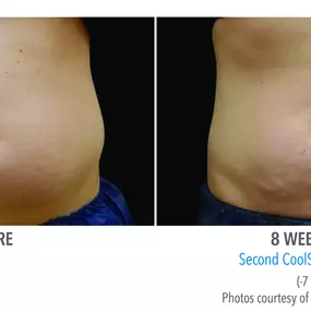 Coolsculpting Centennial