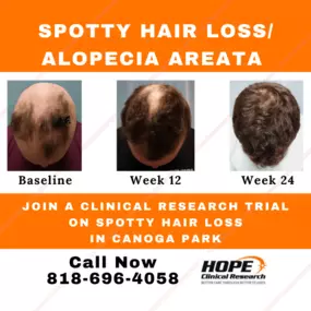 Join an Alopecia Areata clinical research trial in Canoga Park and gain exclusive access to advanced medication. You will be reimbursed for your time and travel costs. Space is extremely limited. Call 818-696-4058 to find out if you qualify.
#SpottyHairLoss #ClinicalResearchTrial #LosAngeles #AlopeciaAreata